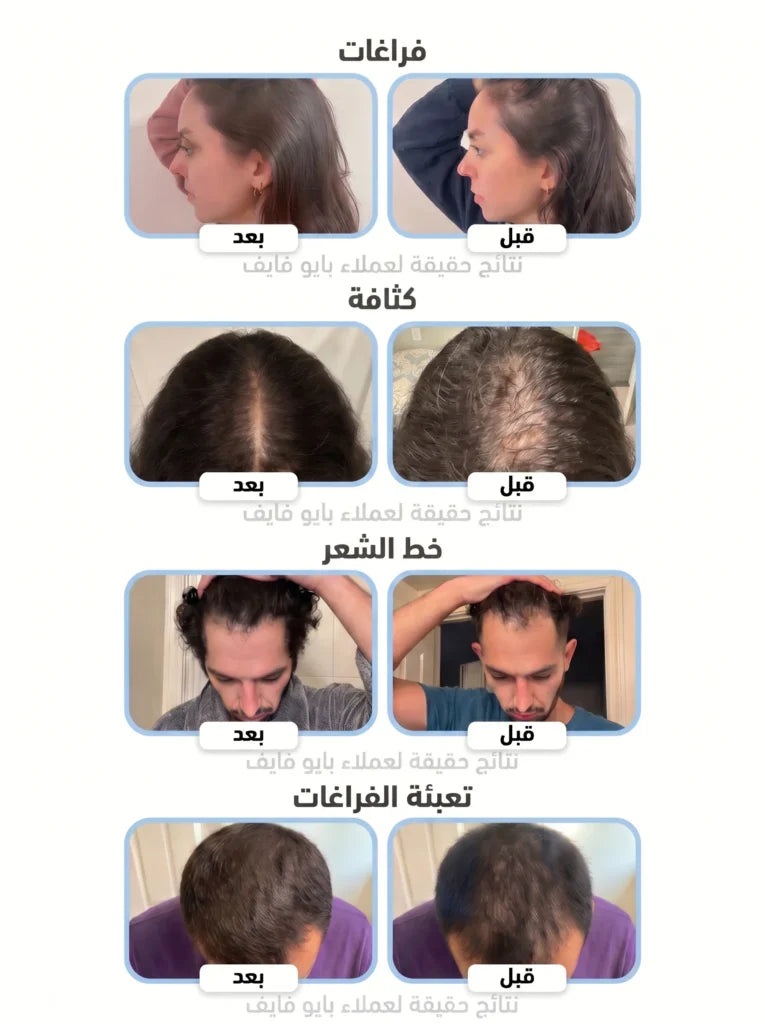 3-Month Course: Integrated System for Falling and Damaged Hair: 35% OFF + Free Shipping + Free Hair Growth Stimulation Comb