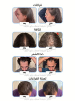 3-Month Course: Integrated System for Falling and Damaged Hair: 35% OFF + Free Shipping + Free Hair Growth Stimulation Comb