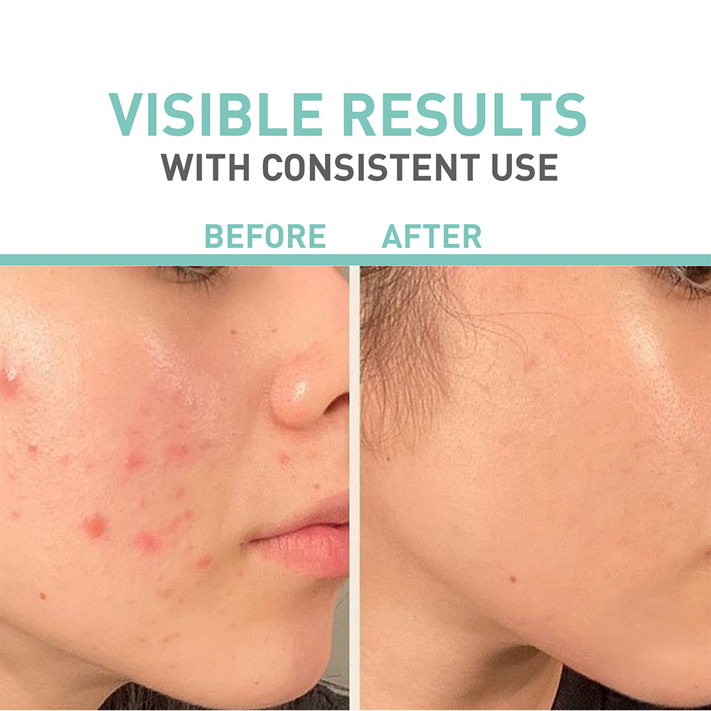 Bionnex Rensaderm Repairing & Sebum Control Cream 30ml