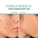 Bionnex Rensaderm Repairing & Sebum Control Cream 30ml